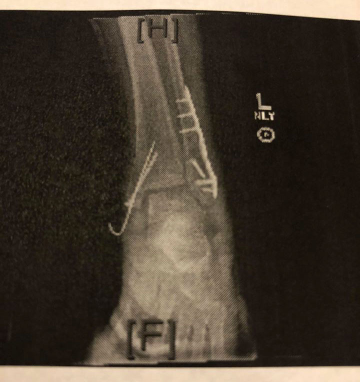 Broken-Ankle-3.jpg